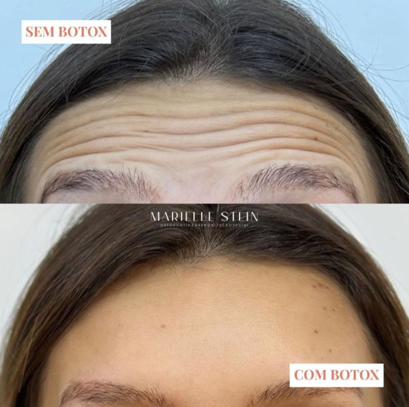 Botox Antes e Depois - Botox em Novo Hamburgo
