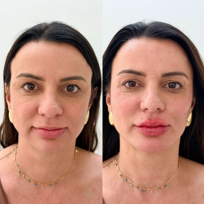 Botox + rejuvenescimento