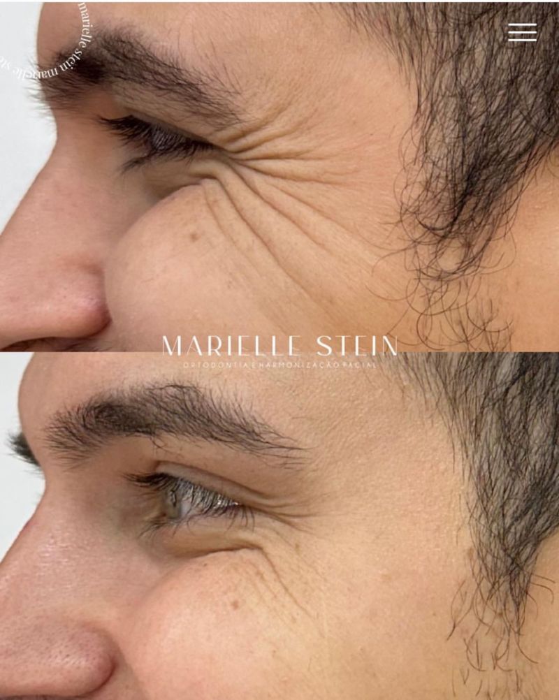 Botox Antes e Depois - Botox em Novo Hamburgo