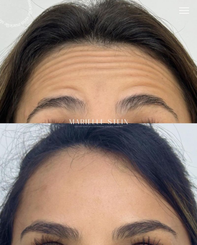 Botox Antes e Depois - Botox em Novo Hamburgo
