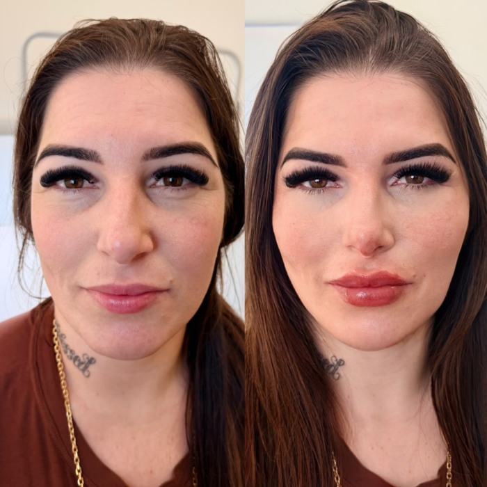Botox em Novo Hamburgo