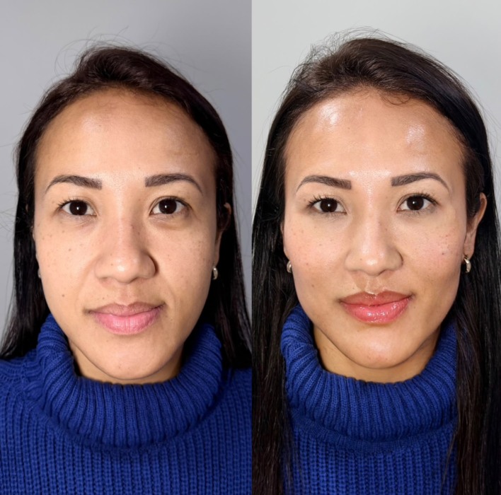 harmonização facial em Novo Hamburgo