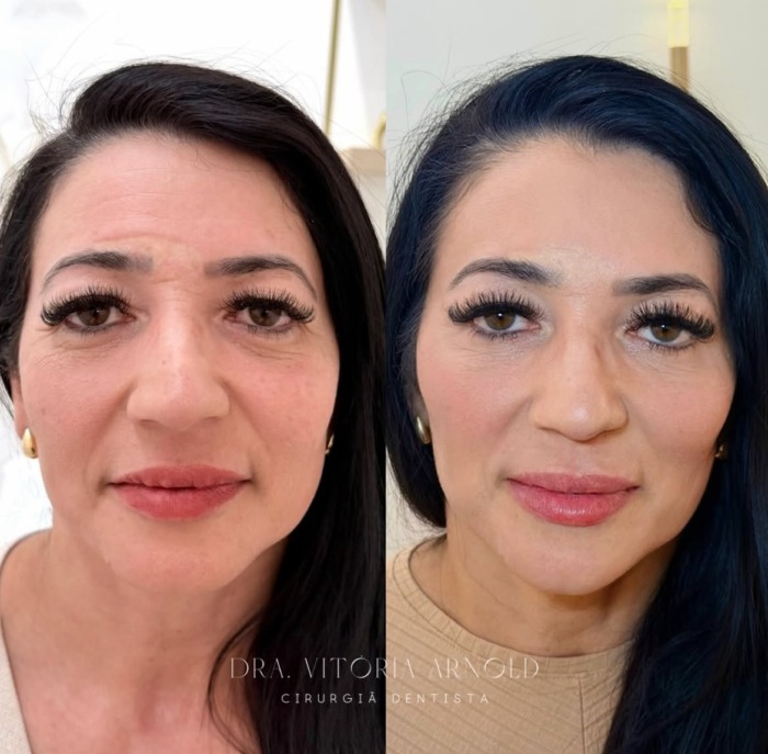 Full Face + toxina botulínica